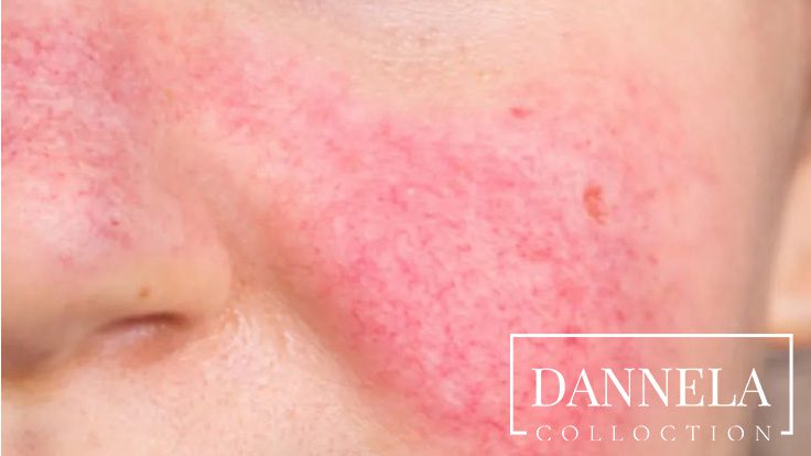 چرا پوست صورتم قرمز میشود؟ بررسی ۱۰ دلیل اصلی قرمزی و التهاب صورت + راهکار درمانی 1 Untitled 1