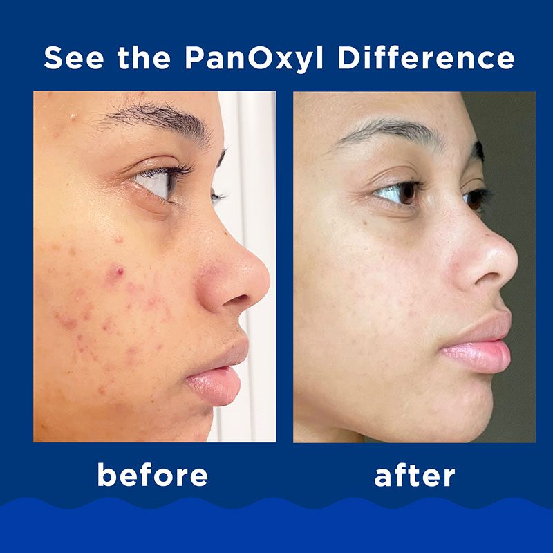 فوم شوینده ضد جوش بنزوئیل پروکساید 10% پانوکسیل Panoxyl 2 10PercentWashPDP 10