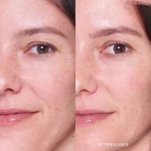 و بعد ماسک لایه بردار اوله هنریکسن min 350x350 1